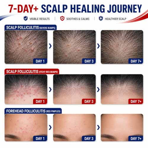 Benzoyl Peroxide Folliculitis Cream, Anti Itch Cream Extra Strength, Fast-Acting Acne Cream for Folliculitis, Razor Bumps & Ingrown Hair, Itch Cream, Psoriasis Scalp Treatment, 3.53 Oz