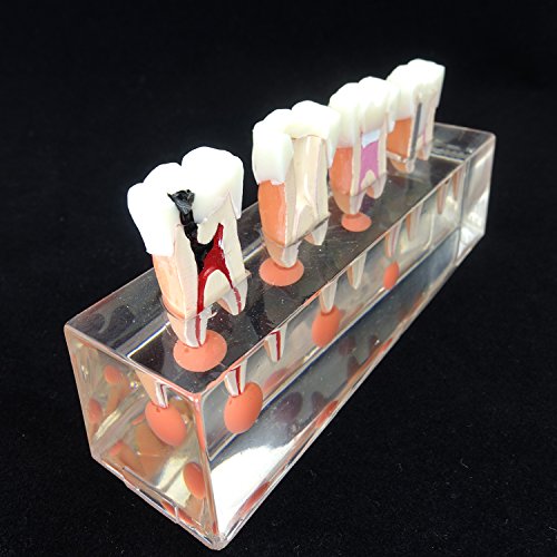 Dental Teeth Model 4-Stage Endodontic Treatment Model for Studying and Teaching …