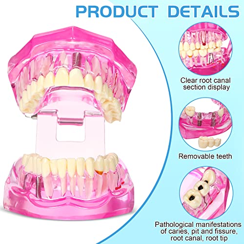 Outus Dental Typodont Model Removable Tooth Implant, Pink, 1 Pcs