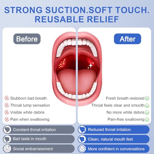 Tonsil Stone Remover, 12-in-1 Tonsil Stone Removal Kit with 5 Adjustable Suction Levels, Built-in LED Light, One-Touch Pause, 5X Magnifying Mirror, Electric Vacuum Suction Tool for Oral Care White