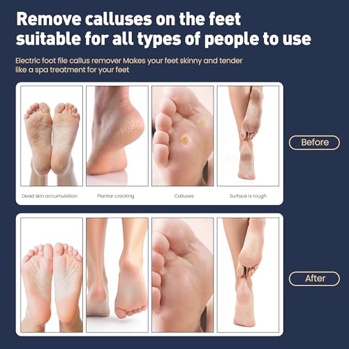 Electric Foot Callus Remover,2 in1 Rechargeable Callus Remover for Feet,9-Speed Cordless Electric Foot File Nail Grinder,Foot Scrubber Pedicure Tools for Dead Skin Dry Cracked Feet(Fold Gold) Gold Fold
