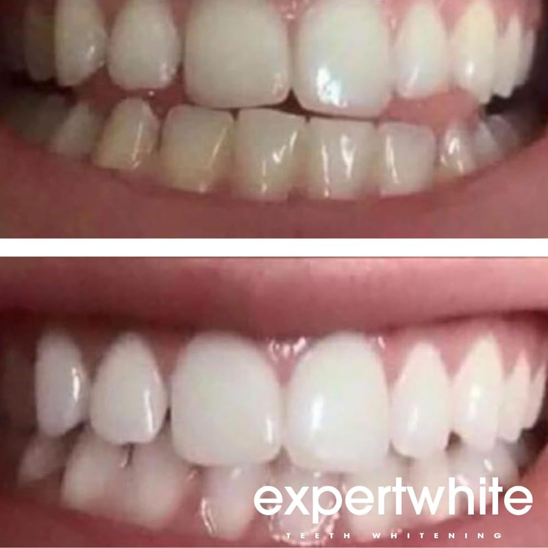 Ultra+ 44% Teeth Whitening Gel Refills for Trays. Carbamide Peroxide Strongest Dental Tooth Bleaching Syringe for Brite Teeth Smile (4 gels, 3cc Each, 15 Minutes). Gels only. No Trays. - BeesActive Australia