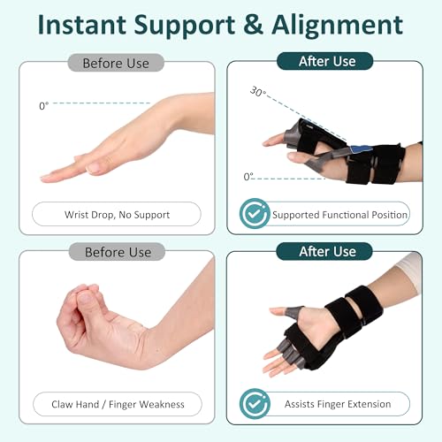Radial Nerve Palsy Splint Wrist Drop Brace for Finger Extension, Adjustable Stroke Hand Recovery Device for Finger Limp, Wrist Drop, Crutch Palsy, Resting Hand MCP Splint Fits Left/Right