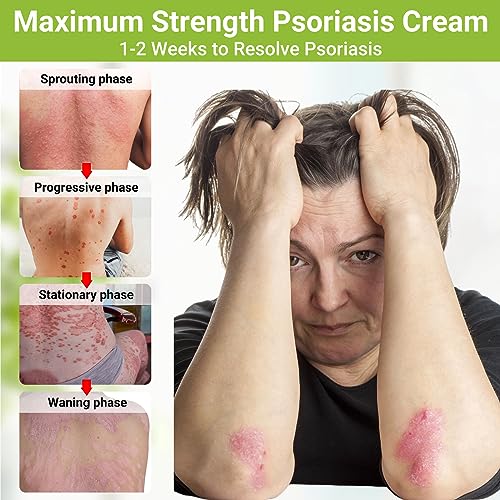 Psoriasis Cream, Maximum Strength Treatment Moisturizing Cream for Psoriasis, Dermatitis, Rash, Anti-Itch, Redness, Flaking, Scaling, Fast Acting Relief for Irritated, Dry Skin 1.76oz