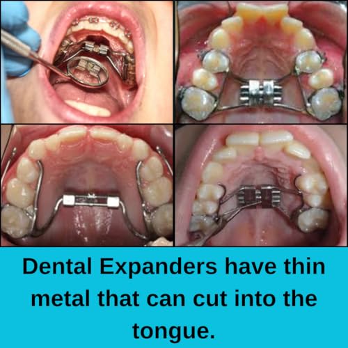 RPE Tongue Guard: Prevents and Helps Heal Tongue Sores Caused by Dental Expanders | Tongue Sores | Metal Cuts | Dental Ortho Braces |