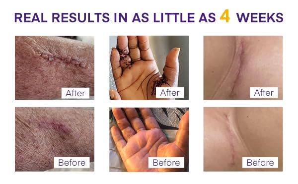 Silicone Scar Gel Scar Cream: SPF 30 Advanced Medical-Grade Formula for Surgical Scars, C-Section, Stretch Marks, Acne, Burns, Keloids, Old & New Scars – Broad Spectrum UV Protection 1.06oz (30g) - BeesActive Australia