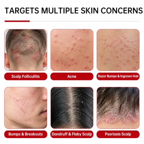 Benzoyl Peroxide Folliculitis Cream, Anti Itch Cream Extra Strength, Fast-Acting Acne Cream for Folliculitis, Razor Bumps & Ingrown Hair, Itch Cream, Psoriasis Scalp Treatment, 3.53 Oz