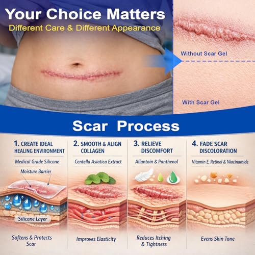 Morovan silicone scar removal Gel: Scar cream for Body and face Effectively minimizes the appearance of Scars from Stretch Marks Surgical Scar Keloids Acne Burns and Other, New scar 6 weeks