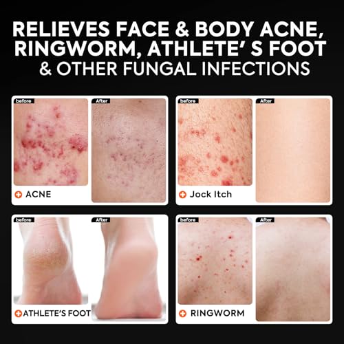 Antifungal Black Soap with Charcoal & 1% Tolnaftate - 3 Packs