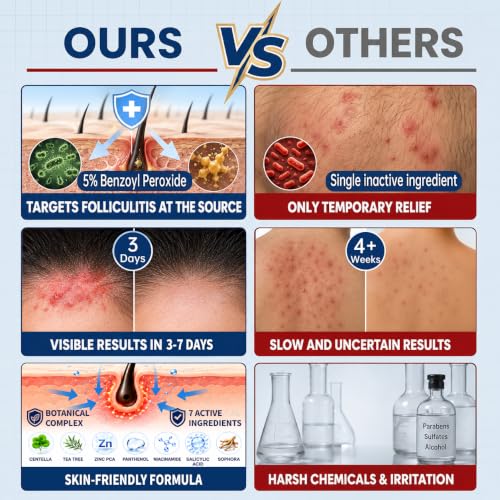 Benzoyl Peroxide Folliculitis Cream, Anti Itch Cream Extra Strength, Fast-Acting Acne Cream for Folliculitis, Razor Bumps & Ingrown Hair, Itch Cream, Psoriasis Scalp Treatment, 3.53 Oz