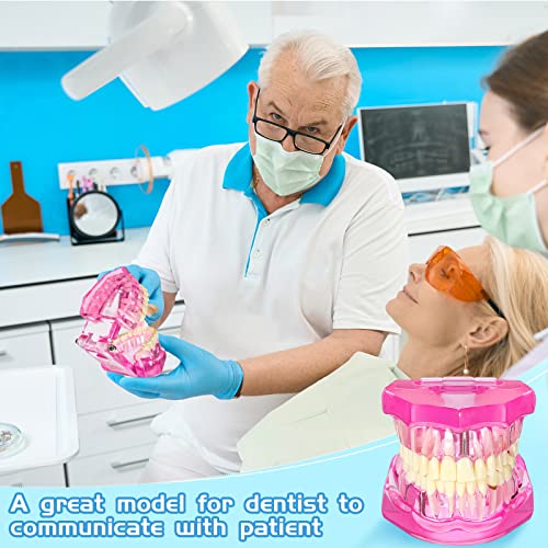 Outus Dental Typodont Model Removable Tooth Implant, Pink, 1 Pcs