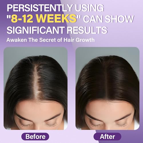 5% Minoxidil Foam for Women Hair Growth Foam