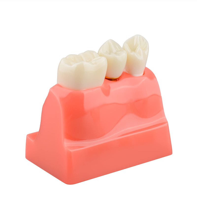 Ultrassist 4 Times Dental Implant Model for Patient Education Pink