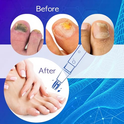 Fungal Nail Pen, Toenail Fungus Pen, Nail fungus treatment For Toenails & Fingernails to Repair Nails by Fungi - 3 Pcs 3 pc