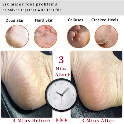 Kinepi Callus Remover Foot File, Pumice Stone for Feet Scrubber Wet and Dry Flat