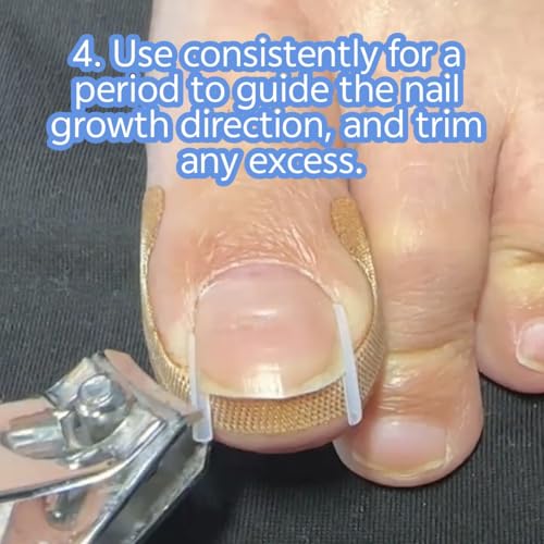 Ingrown Toenail Corrector Kit - Professional Painless Correction Strips & Pedicure Tools for At-Home Care