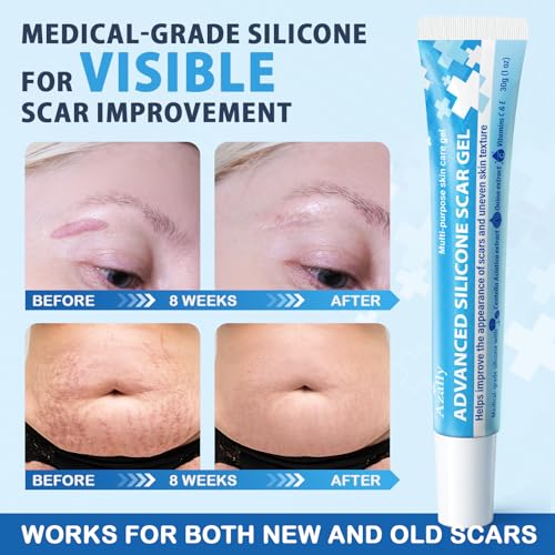 Scar Gel for Keloid Bump Removal: Medical-Grade Scar Cream for Surgical Scars, Stretch Marks, Keloid Bumps, Burn Scars, Acne Scars & C-Section Recovery – Enriched with Centella, Onion Extract 1oz 1 Ounce (Pack of 1)