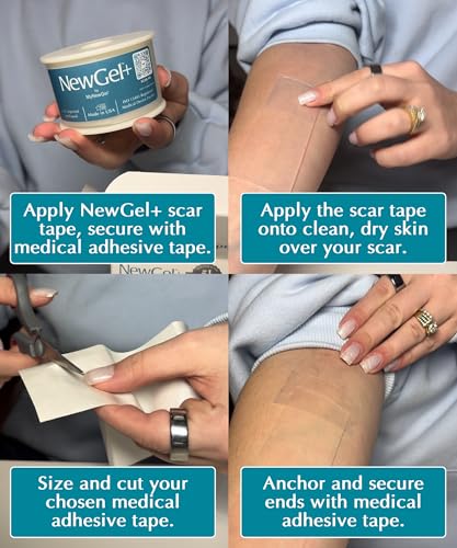 NewGel+ Medical-Grade Silicone Scar Tape Roll, 1.5" x 48" by MyNewGel 48" Roll