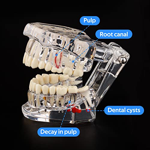 Ultrassist, Transparent Disease Teeth Model 2-Pack with Removable Teeth