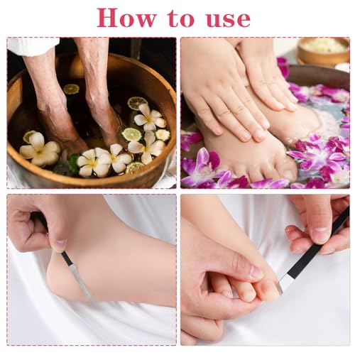 6 Pack Ingrown Toenail Removal Kit, Professional Pedicure Tools for Ingrown Toenail Callus Shaver Corn Removers for Toes Stainless Steel Nail Knives Kit with Storage Box