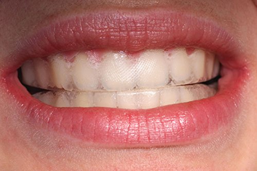 Teeth Whitening Trays Moldable — Ultra White 0.75mm Ultra-Thin, 4 Trays + Storage Case | Compatible with All Whitening Gels | BPA-Free | Dentist-Grade | Made in USA| Instructional Video Included