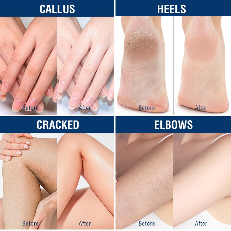 OUKEYA Urea Cream 42% plus Salicylic Acid 2% Net 350g for Dry Cracked Feet, Heels, Knees, Elbows, Hands Repair Treatment.Moisturizes and Removes Corns,Calluses,Dead Skin,and Softens Toenails 12.35 Ounce (Pack of 1)