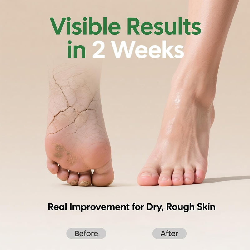 60% Urea Cream with 2% Salicylic Acid, Urea Cream 60 Percent for Feet & Hands, Maximum Strength Moisturizer Foot Lotion for Dry Cracked Heels Feet Knees Elbows Hands, Callus Remover, 10.1 fl oz - BeesActive Australia