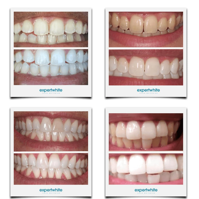 Ultra+ 44% Teeth Whitening Gel Refills for Trays. Carbamide Peroxide Strongest Dental Tooth Bleaching Syringe for Brite Teeth Smile (4 gels, 3cc Each, 15 Minutes). Gels only. No Trays. - BeesActive Australia