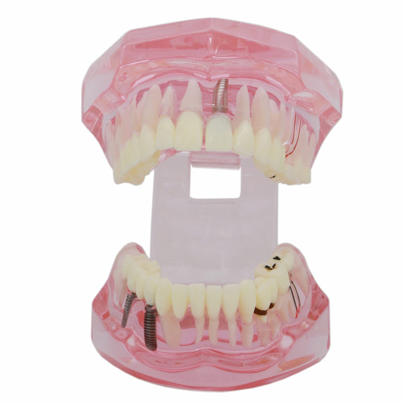 Teeth Model Teeth Typodonts Dental Implant Study Analysis Demonstration Teeth Model #2001 with Restoration Pink - BeesActive Australia