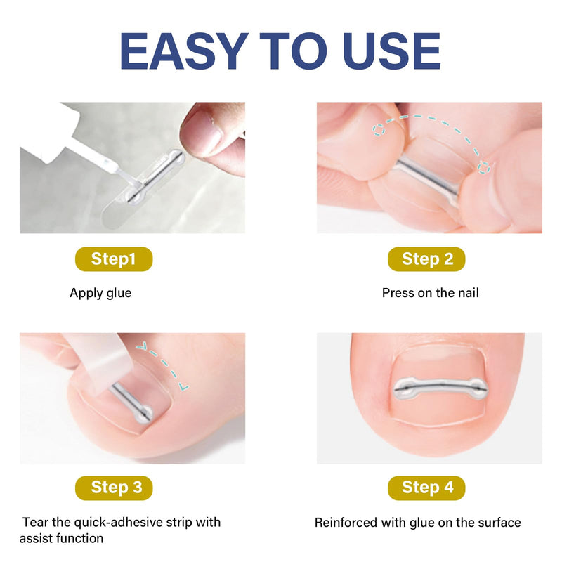 Ingrown Toenail Treatment-Patch(10pcs), Ingrown Toenail Corrector(Titanium Alloy), Ingrown Toenail Removal Kit, Cuttable Applicable for Any Nail Size, Nail Repair for Finger and Foot, Reusable Blue