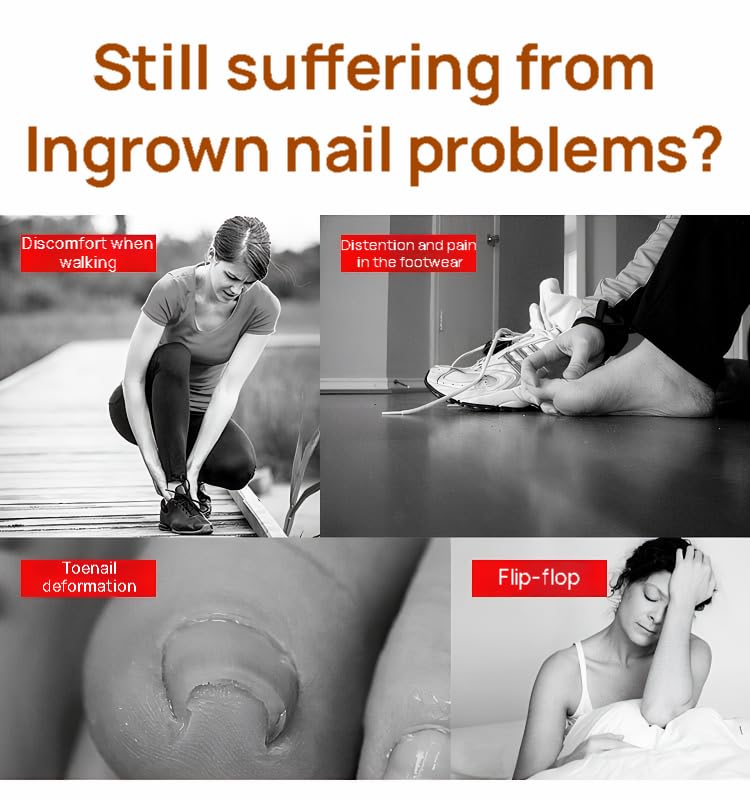 Ingrown Toenail Corrector Kit, 16PC Professional Ingrown Toenail Removal Kit with Correction Strips, Painless Treatment for Ingrown Toenail Pain Relief for Home Pedicure Care