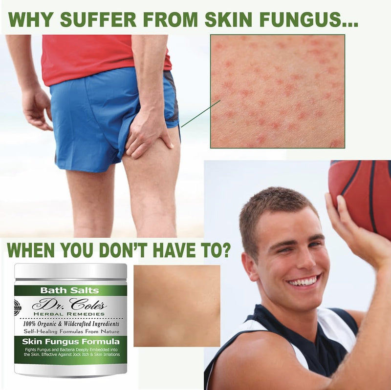 Dr. Cole’s Organic Herbal Skin Fungus Soaking Salts – May Assist with Skin Fungus Infections, Jock Itch, Athlete’s Foot, etc