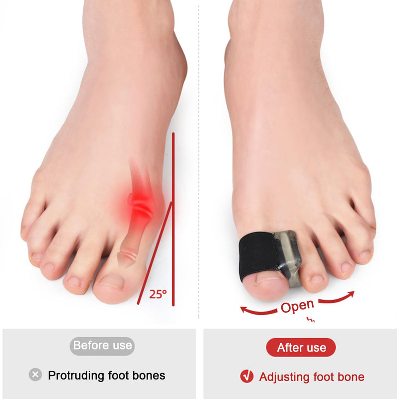 Big Toe Separator,Bunion Corrector,Toe Spacers,Hallux Valgus Splint,Toe Protector Relief Pain from Bunion, Overlapping, Drifted Toe or other Discomfort Large Beige - BeesActive Australia
