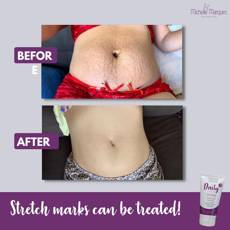 Michelle Marques Stretch Mark Cream, Soften and Reduce the Appearance, Provides Hydration, and Improves Skin Elasticity and Texture, 5.29oz