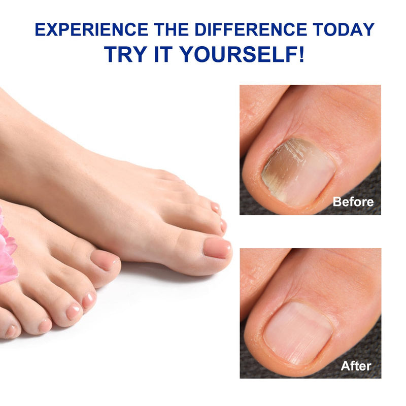 Toenail Treatment Extra Strength-8-Hrs Overnight Nail Repair,ingrown toenail treatment,Strengthens Brittle Nails,Improves Texture & Thickening Hypoallergenic Easy (64 Patch) 1 Count (Pack of 64)