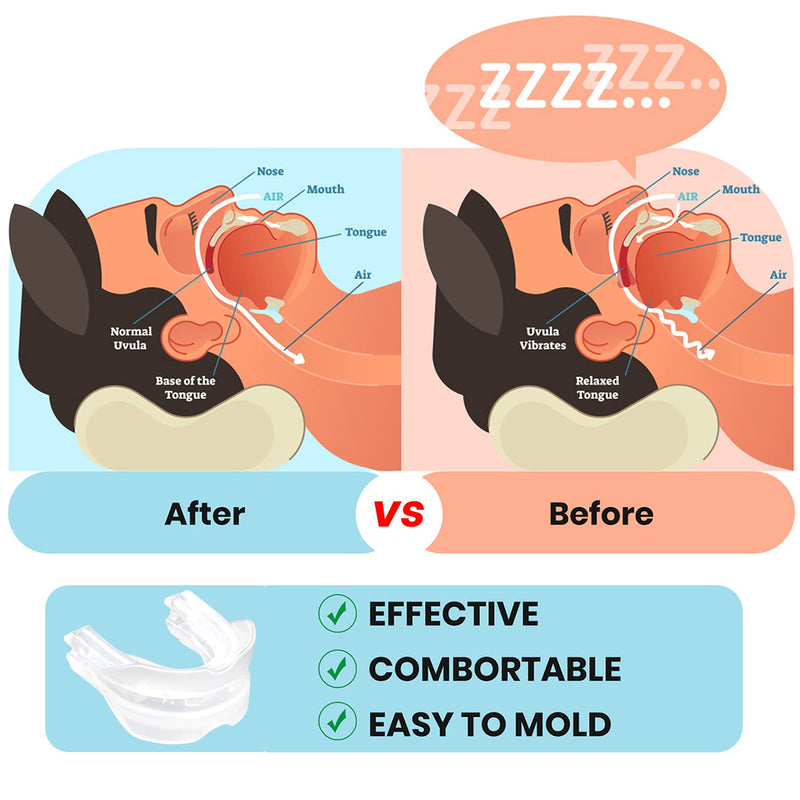 Anti-Snore Device, Snoring Solution Mouthpiece - Stop Snoring Mouth Guard for Men and Women Sleep-N07 White L - BeesActive Australia