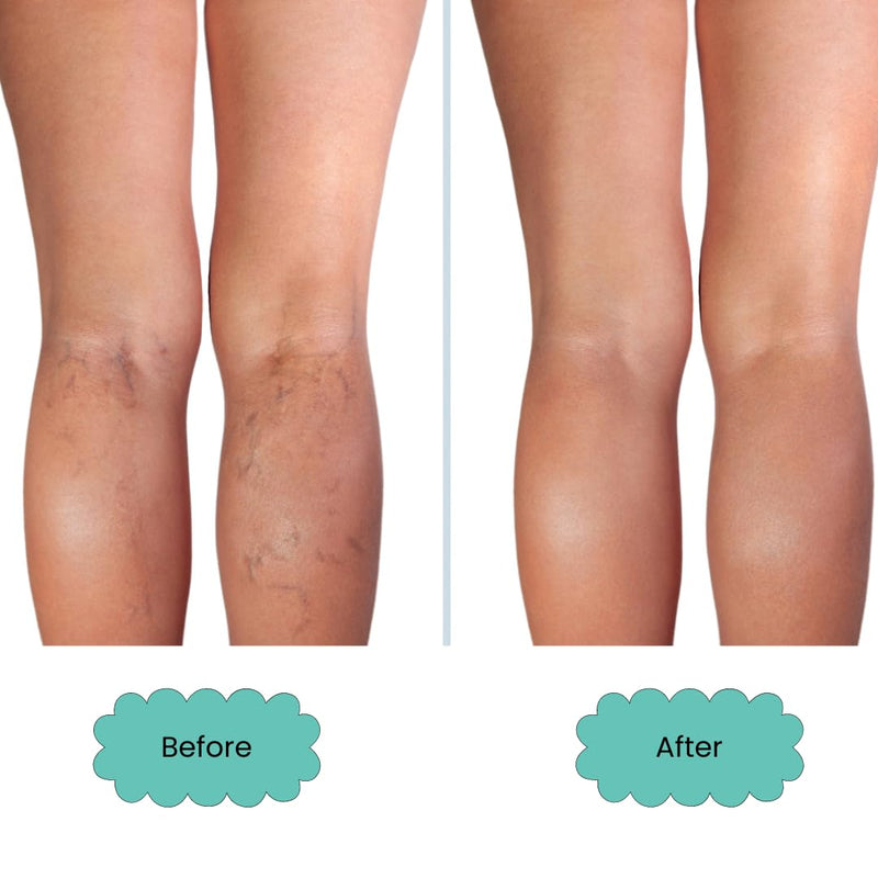 Isabella's Clearly VEIN, Best Natural Varicose Veins and Spider Vein Treatment For Legs, Face, Body | Topical Capillary Health Essential Oils and Herbal Extracts | Horse Chestnut, Helichrysum, Ginger - BeesActive Australia