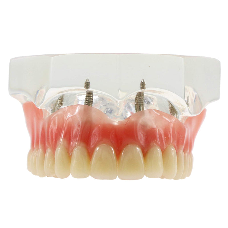 Dental Upper Implants Model Overdenture with 4 Superior Teeth Demo Transparent Vision for Education and Study Model Tool M6001 C
