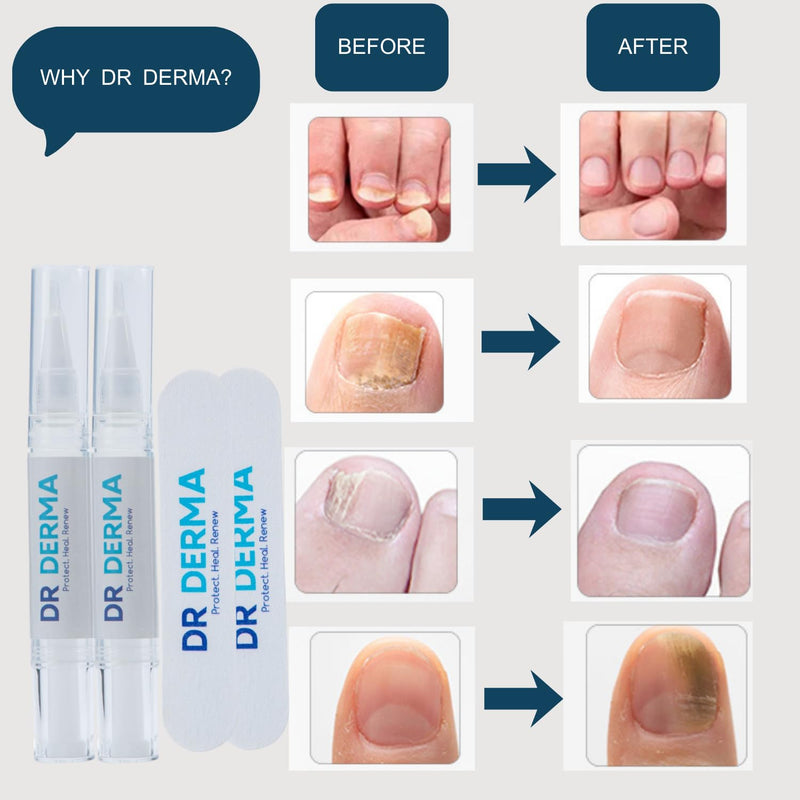 Nail Fungus Pen - Toenail Fungus Treatment Extra Strength with 25% Undecylenic Acid - Helps Repair Discolored & Damaged Nails - With 3 Twist Pens, 5 Nail Files & Instructions, 12ml(4ml Each) - BeesActive Australia