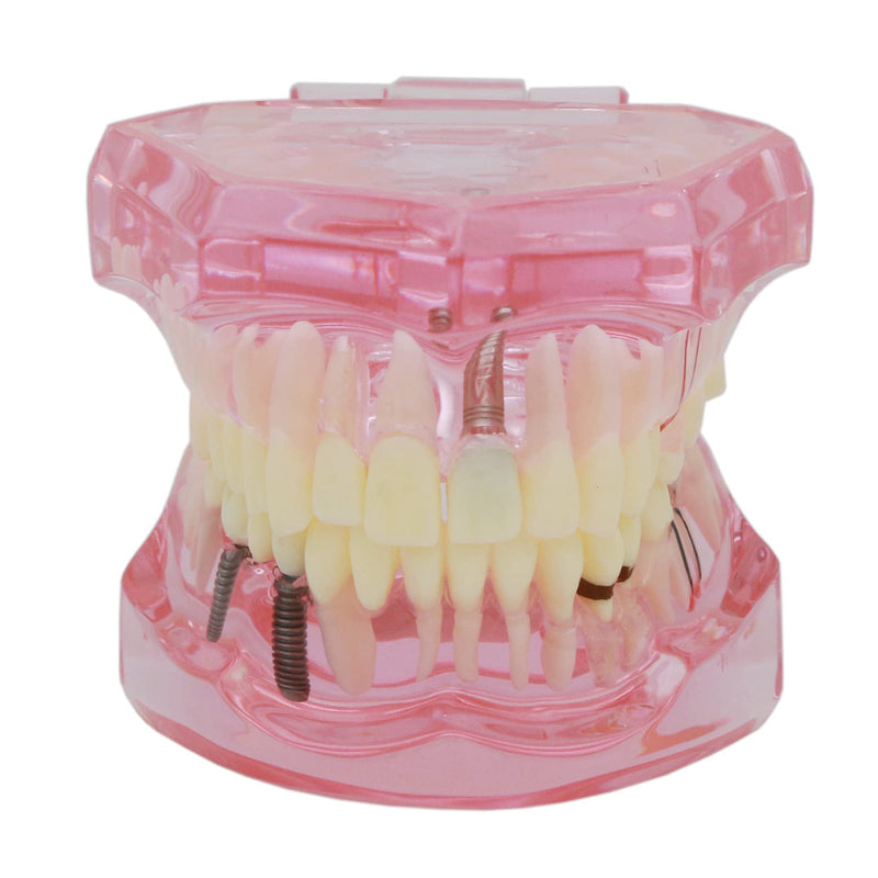 Teeth Model Teeth Typodonts Dental Implant Study Analysis Demonstration Teeth Model #2001 with Restoration Pink - BeesActive Australia