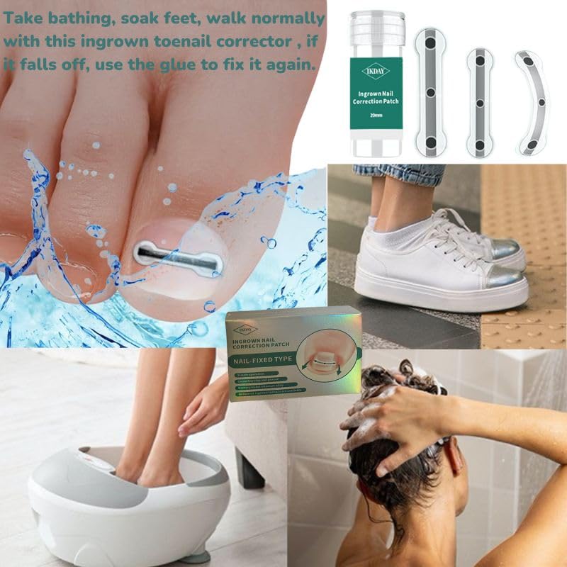 Ingrown Toenail Removal Kit | Titanium Alloy Ingrown Toenail Treatment | Pedicure Tools for Feet, Nail Tools Specially Designed for Curved Nail Repair and Ingrown Toenail Corrector (0.67/0.79in) 0.67/0.79in