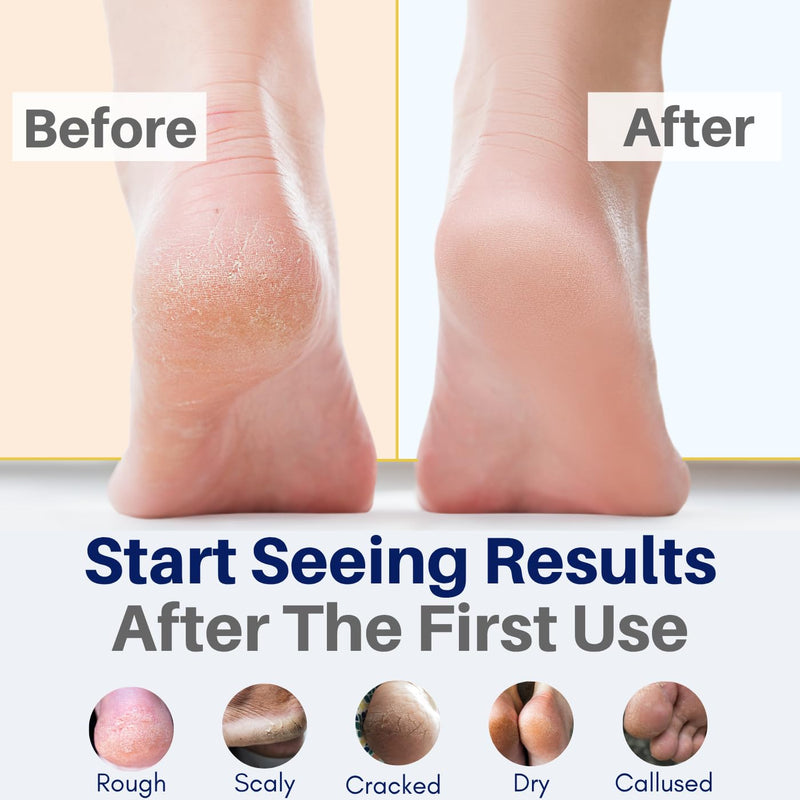 All Natural Foot Cream for Dry Cracked Feet & Heels – USA Made Callus Repair Balm with Organic Ingredients – Moisturizing Athlete’s Foot Relief with Peppermint, Tea Tree, Lavender, & Eucalyptus 4 FL Oz (Pack of 1)