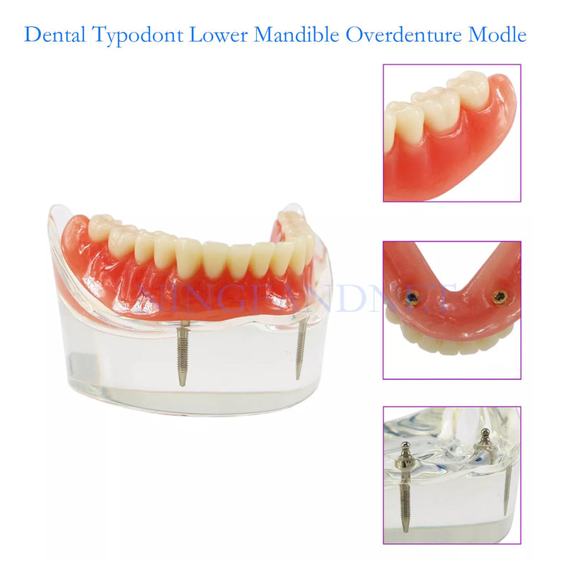 Dental Implant Model, Lower Jaw Overdenture, Removable Overdenture, with 2 Implants,M6002 M602