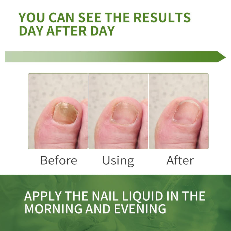 Toenail Fungus Treatment Extra Strength: 7 Pure Natural Plant Extracts，Toe & Fingernail Fungus Renewal - Nail Fungus Treatment Kit with Brush & File - For Ingrown Nails & Discoloration