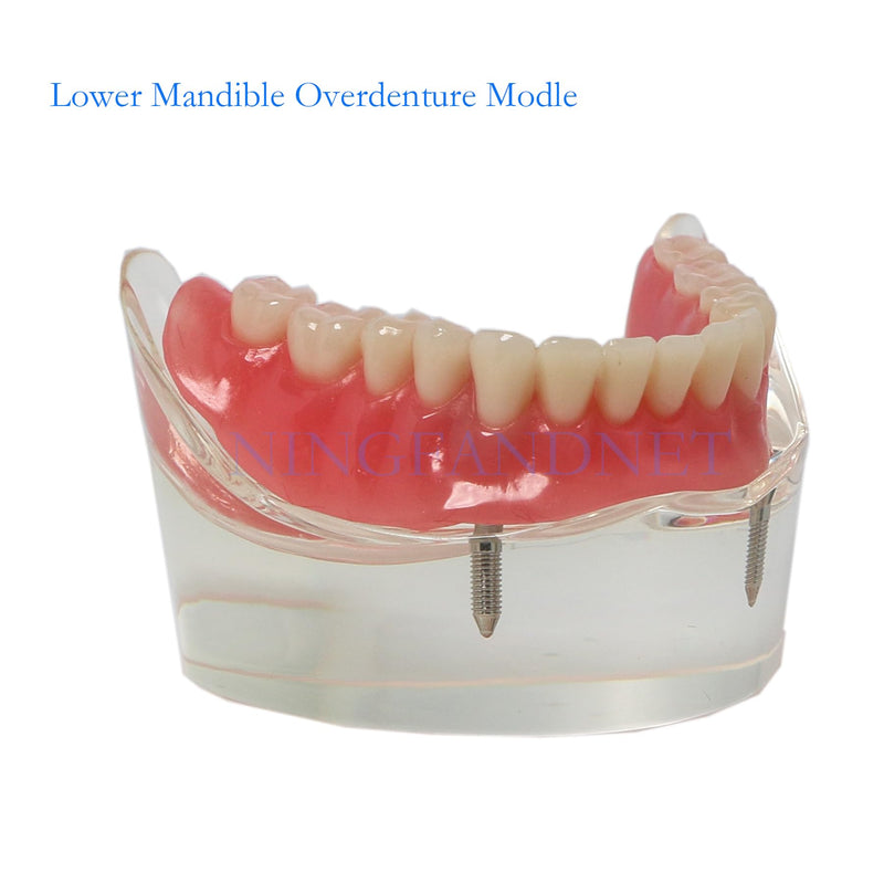 Dental Implant Model, Lower Jaw Overdenture, Removable Overdenture, with 2 Implants,M6002 M602