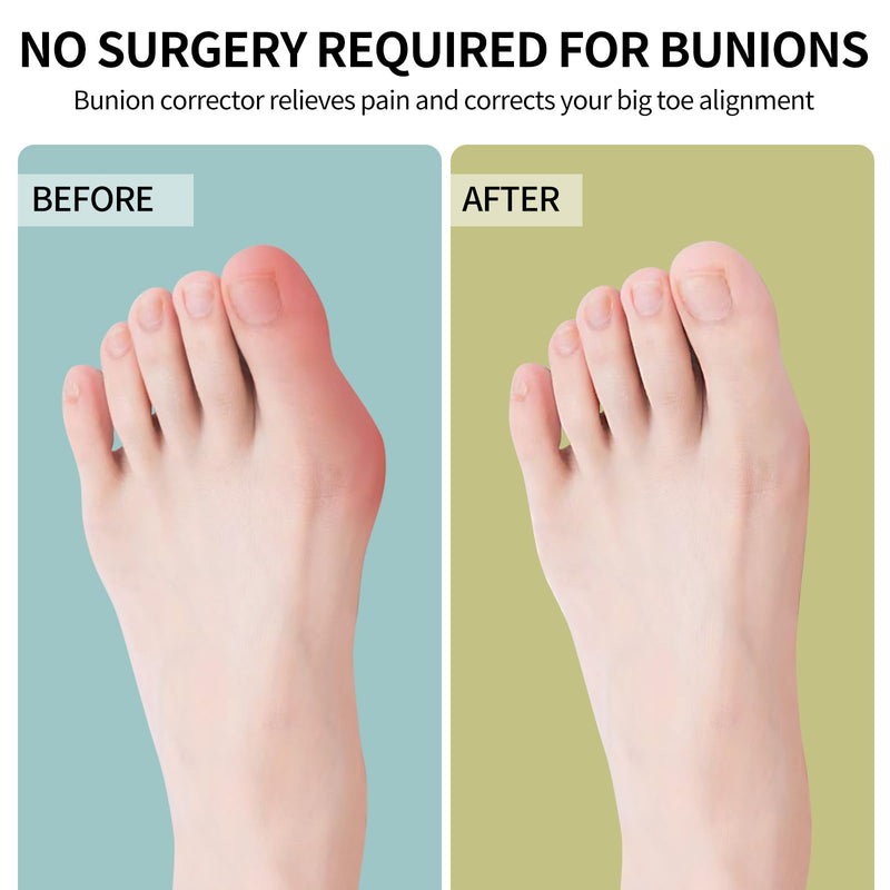 Bunion Corrector for Women & Men ：2-in-1 Adjustable Big Toe Relief Bunion Splints Hammer Toe Straightener，Comfortable, Effective Double Correction，1 set 1 set