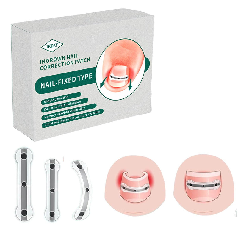 Ingrown Toenail Removal Kit | Titanium Alloy Ingrown Toenail Treatment | Pedicure Tools for Feet, Nail Tools Specially Designed for Curved Nail Repair and Ingrown Toenail Corrector (0.67/0.79in) 0.67/0.79in