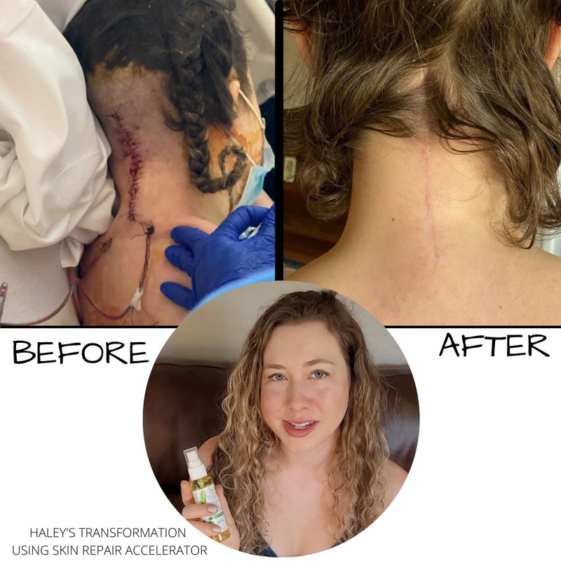 Brittanie's Skin & Scar Repair Accelerator For C Section Recovery, Scars, Stretchmarks & Tattoos | Natural, Non-Toxic Healing Treatment, Dermatologist Recommended, Deeply Nourishes, Reduces Wrinkles