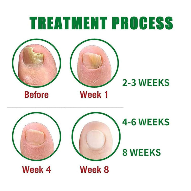 Nail Fungus Treatment Gel - Natural Nail Care Gel, Nail Repair Cream with Colloidal Silver, Emu Oil & Tea Tree Oil for Hydrated, Moisturizing Treatment for Hands & Feet (2pcs) 0.51 Fl Oz (Pack of 2)