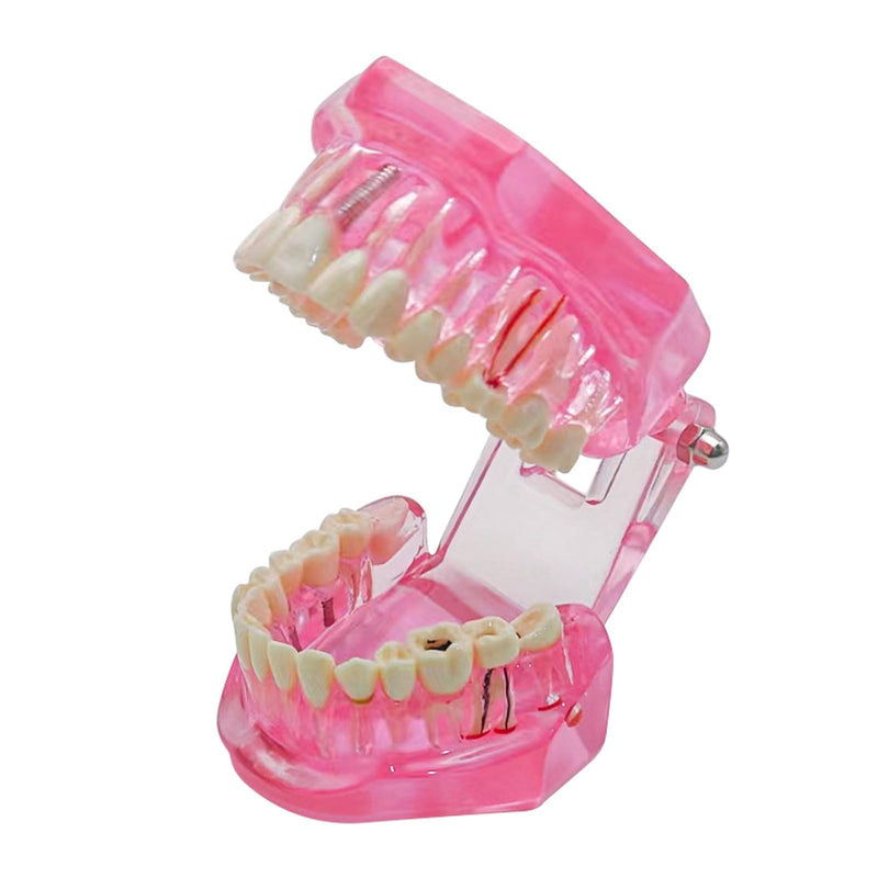 Transparent Disease Teeth Model with Dental Implant Bridge, Dental Teach Crown Bridge Removable Model, Tooth Model for Patient and Dental Student Education. (Red) Red - BeesActive Australia